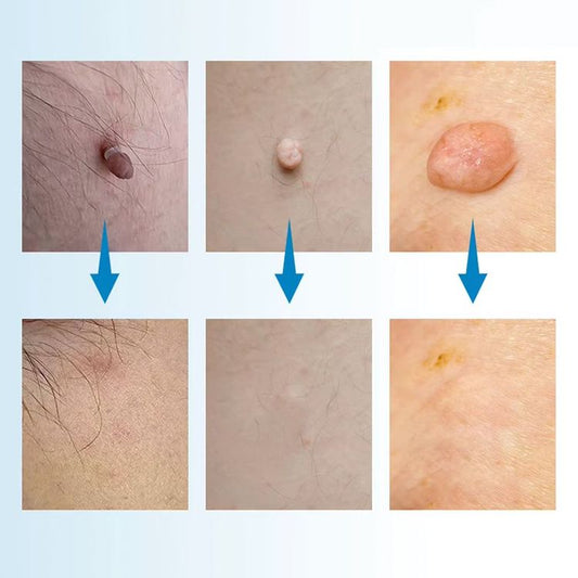 DermaClear™ – Hudflik- & Vårtborttagare