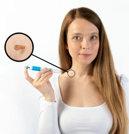 DermaClear™ – Hudflik- & Vårtborttagare